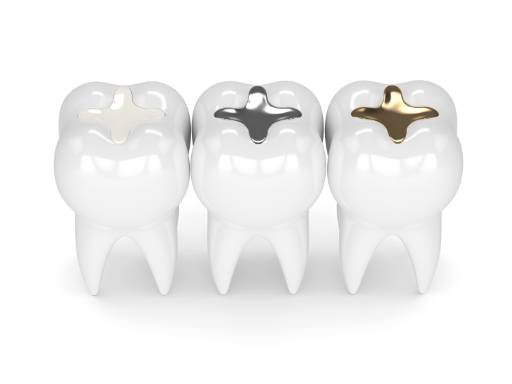 Close up photos of various kinds of dental fillings