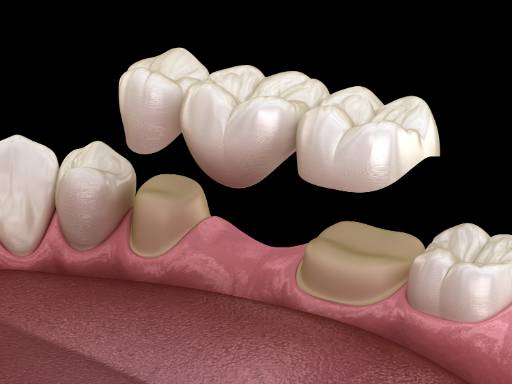 Close up photo of a dental bridge