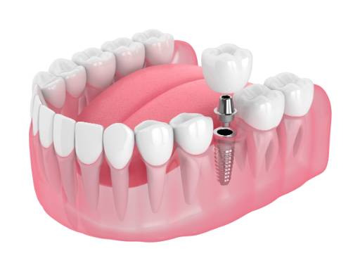 Dental implant dentist in Longmont, CO