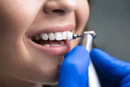 Porcelain dental veneer being polished