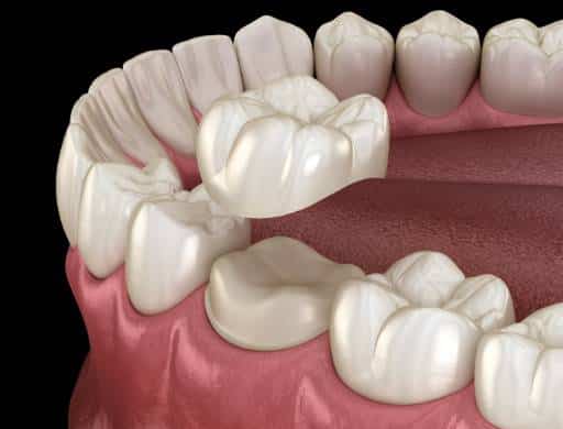 Close up photo of a dental crown