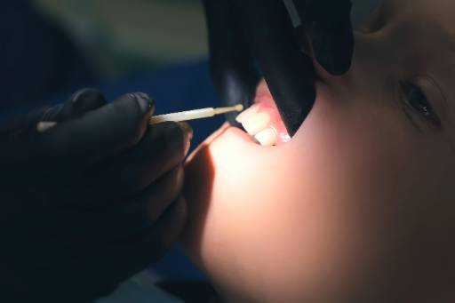 Dental sealant being applied to help prevent tooth decay for a Longmont patient.