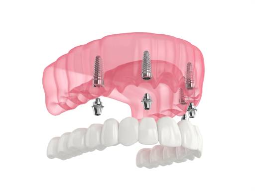 All on X implant supported dentures