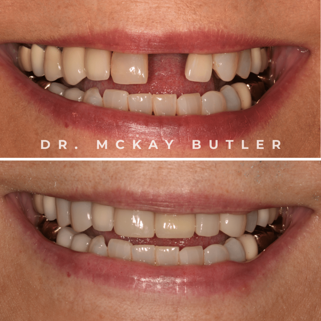 Before and after pictures of patient receiving dental implants in Longmont, CO.