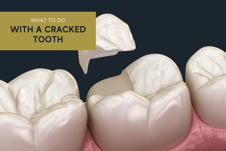 Picture of a cracked tooth for an article on what to do if you crack your tooth by Twin Peaks Family & Cosmetic Dentistry in Longmont CO
